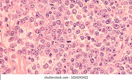 22 Diffuse Large B Cell Lymphoma Images, Stock Photos & Vectors ...