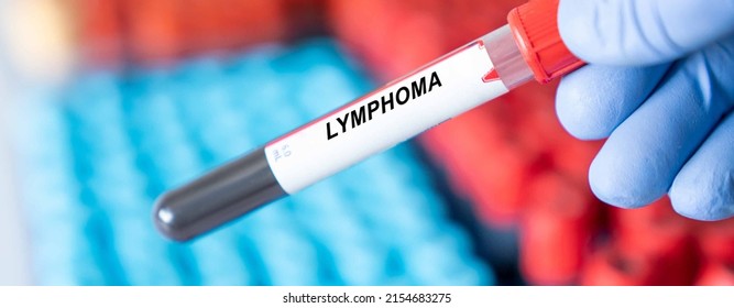 Lymphoma. Lymphoma Disease Blood Test In Doctor Hand