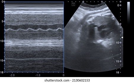 M Mode Ultrasound Scan Of Babies Heartbeat 
