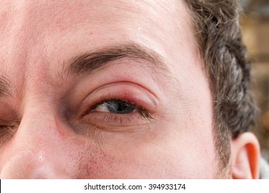 eye tumor