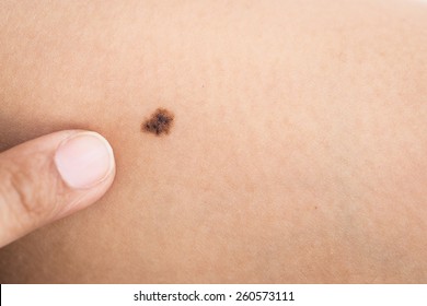 Macro Black Birthmark On Skin