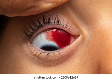 Macro Of Blood In A Child's Eye From Ruptured Capillaries. Closeup Of Subconjunctival Hemorrhage Or Hyposphagma In The Sclera Of The Eye