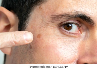 Macro Close Up Detail Of Facial Melanoma On Middle Aged Man. Hand Pointing With Finger At Mole Next To Eye.