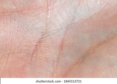 Fungal Infection Groin Psoriasis Dermatitis Eczema Stock Photo (Edit ...