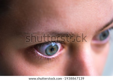 Macro closeup profile portrait of young woman face with Grave's disease hyperthyroidism symptoms of ophthalmopathy bulging eyes and proptosis edema
