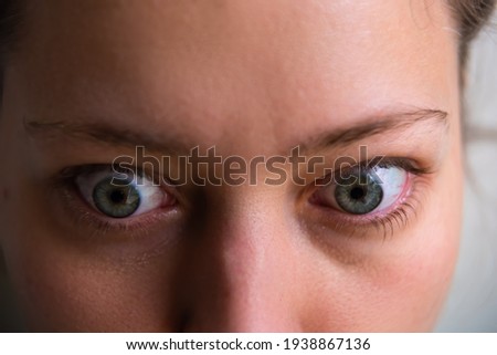 Macro closeup of young woman face with Grave's disease hyperthyroidism symptoms of ophthalmopathy bulging eyes proptosis edema