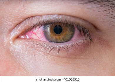 Macro of conjunctivitis red eye.
