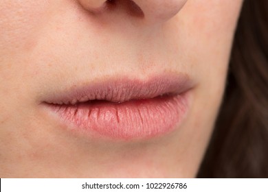 Macro Of Cracked Dry Lips Of Young Woman