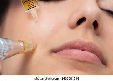 Macro detail of micro needle cosmetic treatment on female cheek. Derma pen and syringe with plant extracts next to face. - Shutterstock ID 1488884834