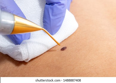 Macro Detail Of Plasma Pen With Gold Head Removing Dark Brown Malignant Wart On Skin.