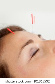 Macro detail of three needles in face of patient