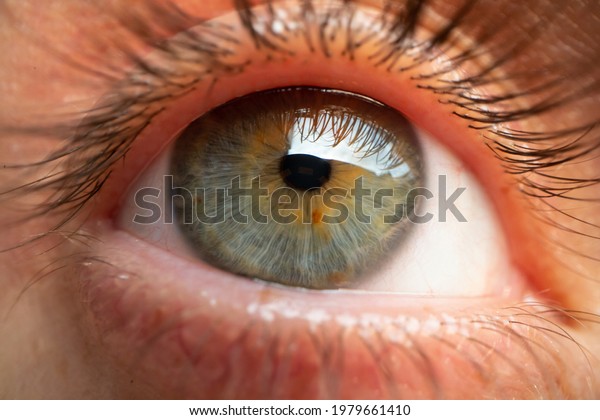 central heterochromia iridum