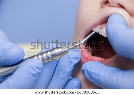 Macro of a diode laser treating gingiva near a child’s incisor during pediatric dental care, highlighting sterile, gentle technique.