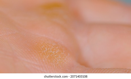 MACRO, DOF: Hard callouses formed on the palm of an unrecognizable male climber. Detailed shot of a worker's hardened skin on the inside of their hands caused by heavy manual labor. Hardened skin.