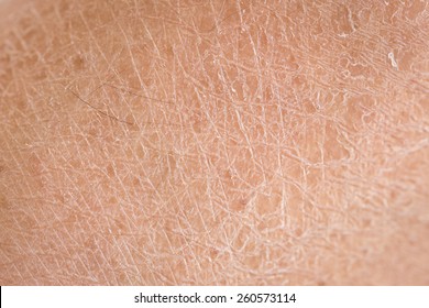 Macro dry skin (ichthyosis) detail
