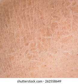 Macro Dry Skin (ichthyosis) Detail