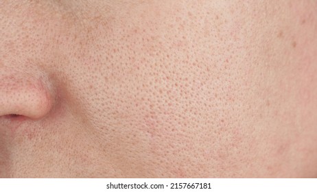 macro enlarged pores. pale skin, cosmetology.