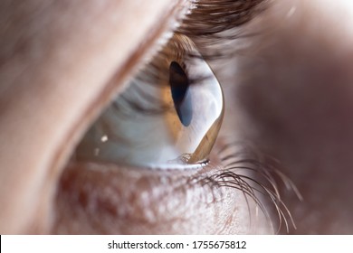 Macro eye photo. Keratoconus - eye disease, thinning of the cornea in the form of a cone. The cornea plastic.