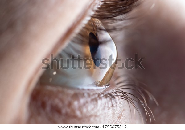 Macro eye photo.\
Keratoconus - eye disease, thinning of the cornea in the form of a\
cone. The cornea plastic.