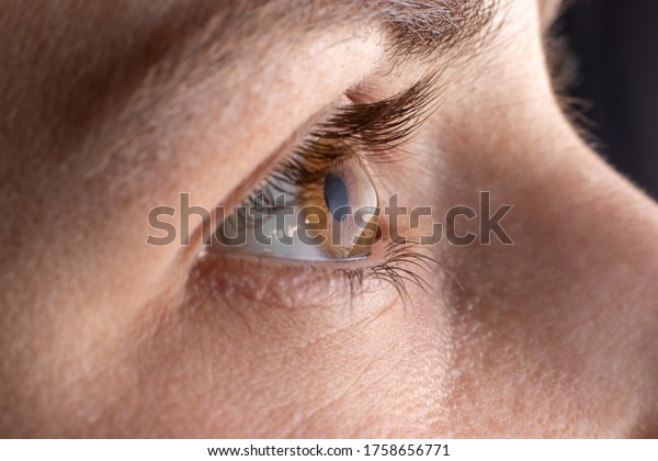 Macro eye photo.\
Keratoconus - eye disease, thinning of the cornea in the form of a\
cone. The cornea plastic.