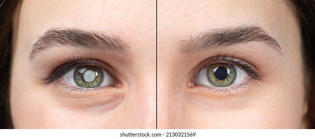 Macro of the eye of a young woman with and without cataracts. Simulation of before and after cataract removal surgery to avoid blindness