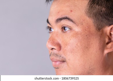 Macro Face Skin Of Asian Man To Show Many Skin Problem. Men Skin Care Concept On Grey Space Background