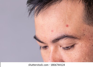 Macro Face Skin Of Asian Man To Show Many Skin Problem. Men Skin Care Concept On Grey Space Background