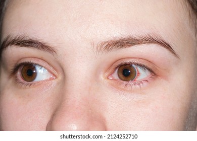 Macro human eyes, burst capillaries, bruising on white of the eye. Red spot after childbirth in a woman in labor, close-up