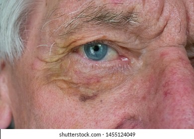 Macro Image Of An Old Man With A Black And Yellow Bruised Eye Socket With Wrinkly Skin