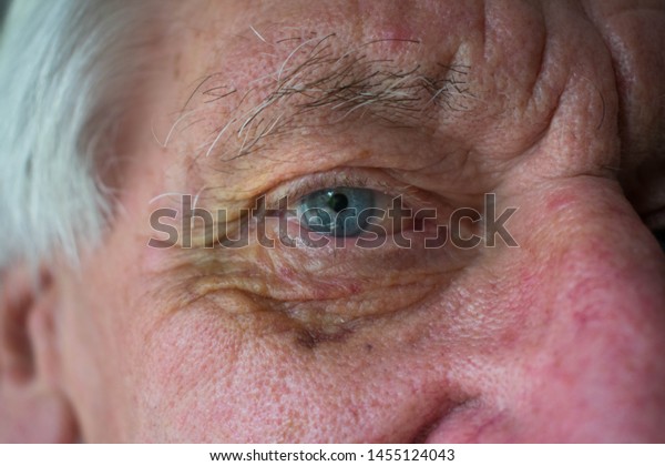 Macro image of an old man with a black and\
yellow bruised eye socket with wrinkly\
skin