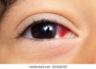 Macro Of Kid Eye With Subconjunctival Hemorrhage. Blood Stain In The Eye Due To Broken Capillaries