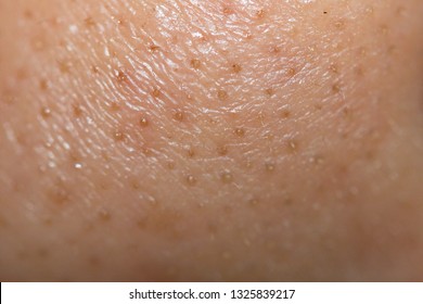 Macro Oily Pore And Acne On Face Skin.