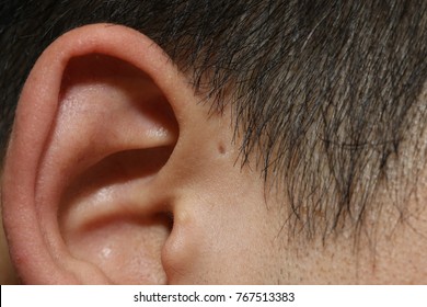 Macro On Fistula Auris Congenita Or A Small Hole On Human External Ear