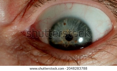 MACRO: Opened bulging human eye, Close shot
