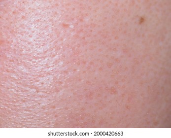 Macro Photo Of Big Pore On Oily Facial Skin Type