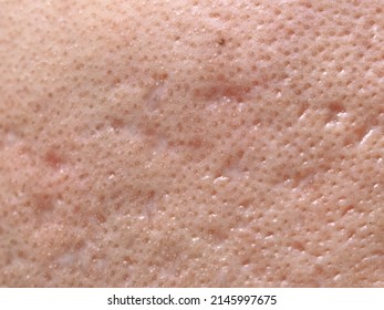 Macro Photo Of Big Pore On Oily Facial Skin Type