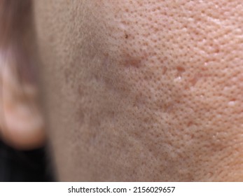 Macro Photo Of Big Pore On Oily Facial Skin Type