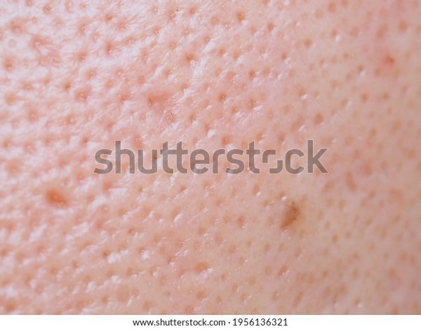 Macro photo of\
big pore on oily facial skin\
type