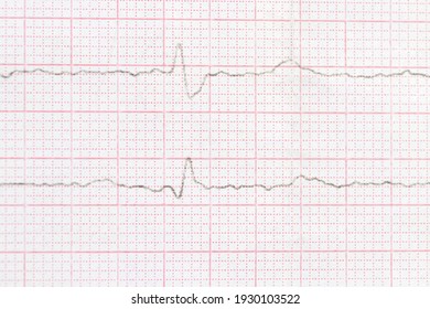 Macro photo or close-up ECG cardiogram of a patient with left bundle branch block. Diagnosis and treatment of heart disease.