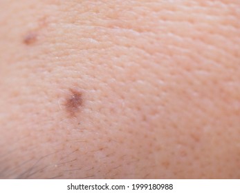 Macro Photo Of Human Facial Skin With Brown Mole And Big Pore On Oily Skin Type