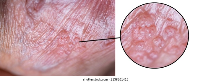Macro Photo Of Human Hpv Papillomavirus, Man With Skin Lesion By Virus.