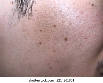 Macro Photo Of Skin Problems In Asian Male Adult: Big Pores On Oily Facial Skin Type And Moles