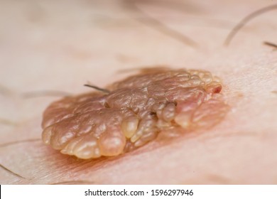 HPV-fertőzés tünetei és kezelése - Íny papilloma képek