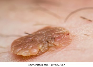 Macro Photo Of A Skin Wart, Papilloma Virus Infection