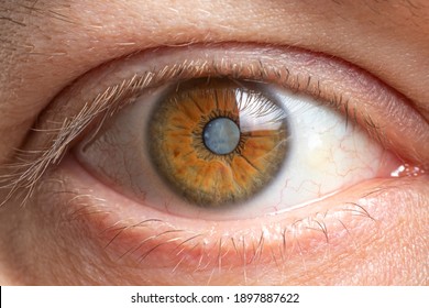 Macro Photos Of The Human Eye - Cataract Clouding Of The Lens, Deterioration Of Vision. Cataract Treatment, Surgery And Ophthalmology