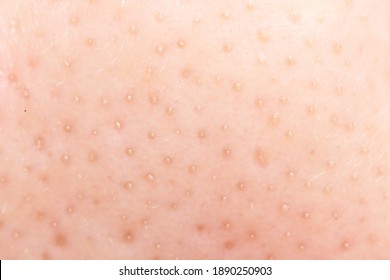 Macro Shot Of Blackheads On Facial Skin, Clogged Pores