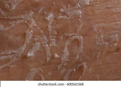 魚鱗癬 の画像 写真素材 ベクター画像 Shutterstock