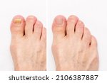 Macro shot of a male foot with yellow ugly fungus on toenails and healthy nails before and after treatmet isolated on a white background. Fungal nail infection. Advanced stage of disease. Top view