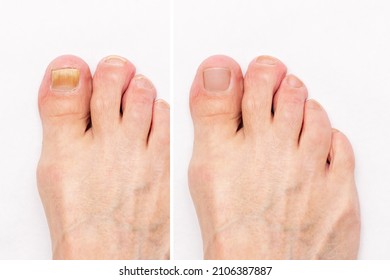 Macro shot of a male foot with yellow ugly fungus on toenails and healthy nails before and after treatmet isolated on a white background. Fungal nail infection. Advanced stage of disease. Top view - Shutterstock ID 2106387887