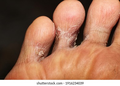 Tinea Pedis Images Stock Photos Vectors Shutterstock